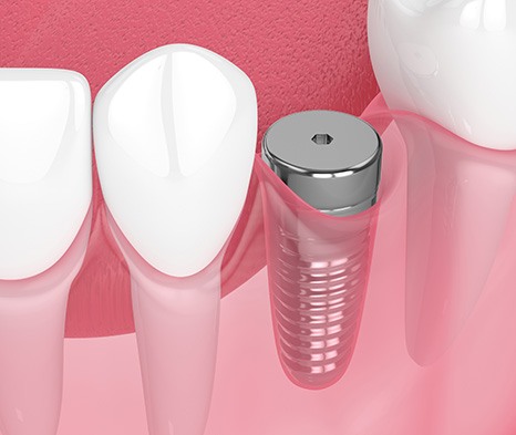 Digital illustration of a dental implant