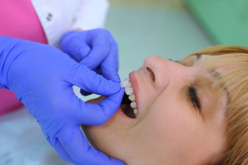 A dentist helping with maintaining your veneers