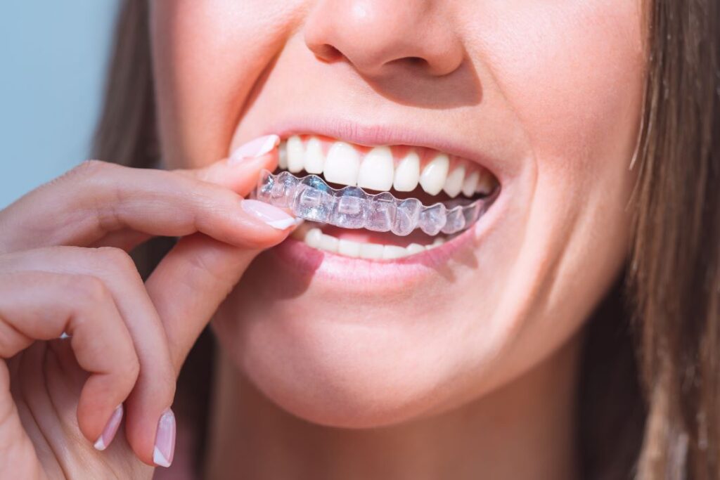 A woman putting a Candid Pro aligner on her teeth.