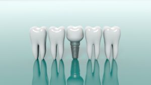 Dental implant between molars